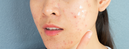 Reactive Skin After Changing Products: Why It Happens & What To Do